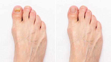 Toenail fungus treatment Fungal toenails, toenail fungus diagnosis and treatment in the Palm Beach County, FL: Boynton Beach (Greenacres, Boca Del Mar, Lantana, Kings Point) and Wellington (Royal Palm Beach, Riviera Beach, Loxahatchee, Westgate) areas
