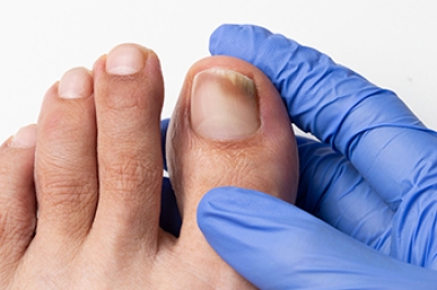 Causes and Implications of Toenail Fungus